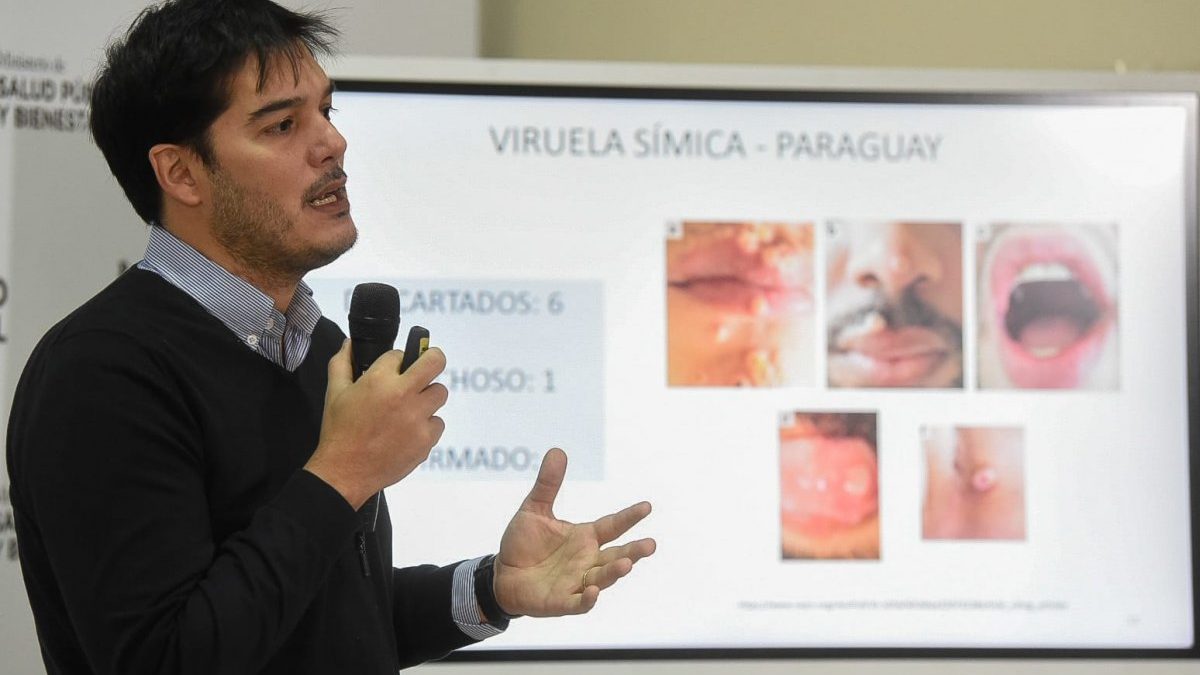 Confirman segundo caso de «viruela del mono» en Paraguay