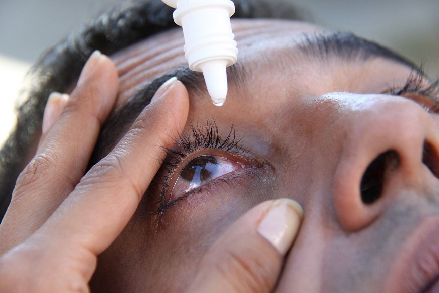 Aumento de casos de conjuntivitis en Ñemby: llaman a consultar ante primeros síntomas